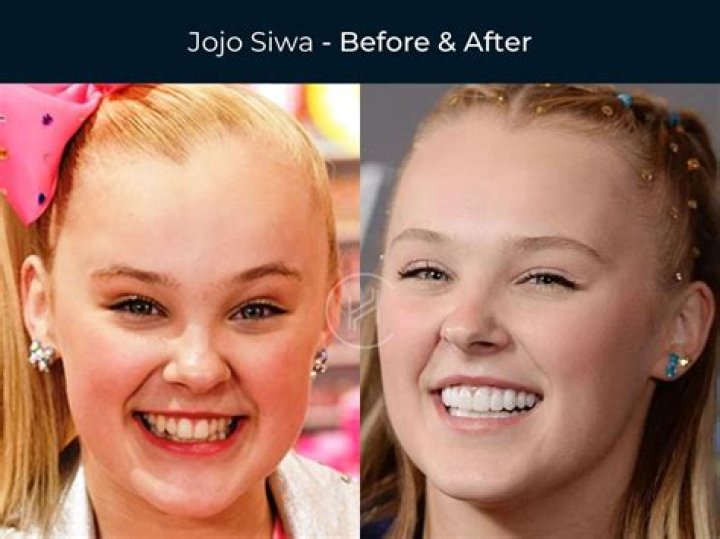Jon Jones Teeth Before And After | What Does He Have On His Teeth