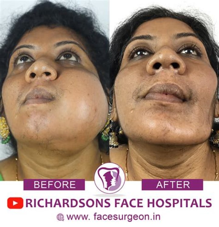 What Happened To Yellowman Face? Tumor Surgery Result Partial Distorted Face