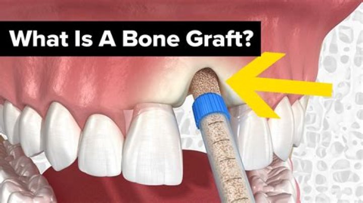 What is graft real name?